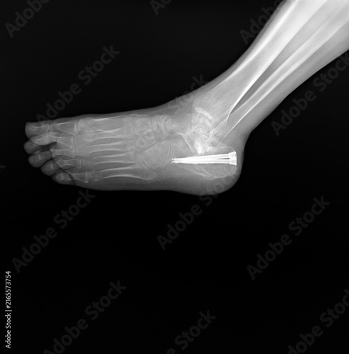 X-ray of a human calcaneus fracture