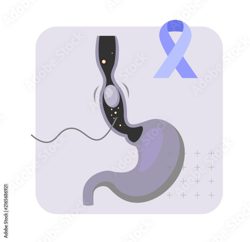 Esophageal Cancer – Symptoms, Awareness, Diagnosis and Treatment - Stock Illustration