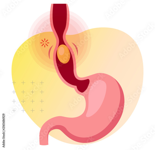 Esophageal Cancer – Symptoms, Awareness, Diagnosis and Treatment - Stock Illustration