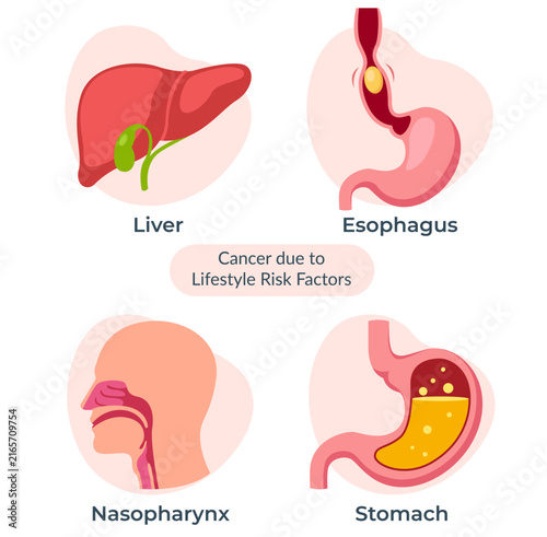 Lifestyle-Related Cancer Risks – Liver, Esophagus, Nasopharynx and Stomach - Stock Illustration