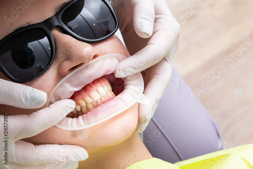 Obraz na płótnie Dentist installing a patient cheek retractor in dentist office
