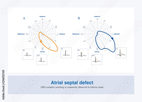 Quadro su tela When there is an atrial septal defect, the descending branch of the QRS complex in leads II, III, and aVF often becomes notched, which is called the crochetage sign