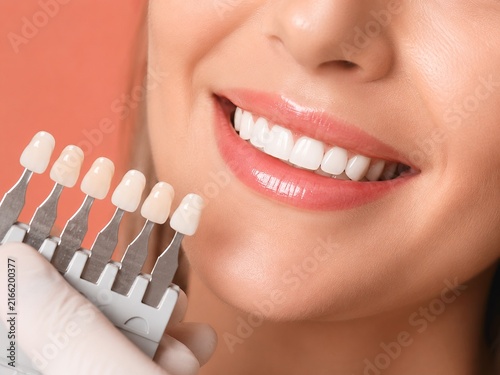 Veneer Color Guide Beside White Smile