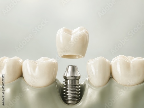 Dental Implant Crown Placement on Green Background