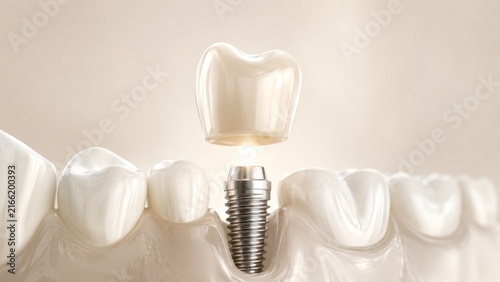 Ceramic Crown Above Dental Implant