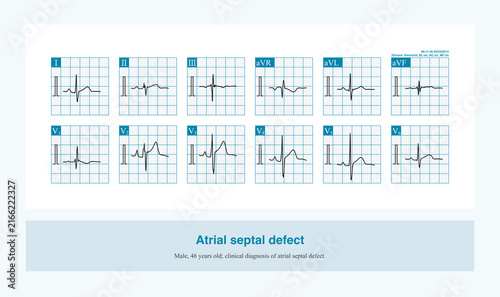 Quadro su tela When there is an atrial septal defect, the descending branch of the QRS complex in leads II, III, and aVF often becomes notched, which is called the crochetage sign