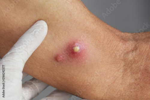 Fotografie Medical examination of inflamed skin boil with pustule and redness