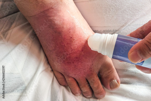 Obraz na plátně Hand applying anti-inflammatory gel onto swollen inflamed painful right foot due