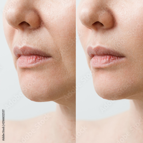 A closeup of a woman face showcasing remarkable skin texture transformation after beauty care