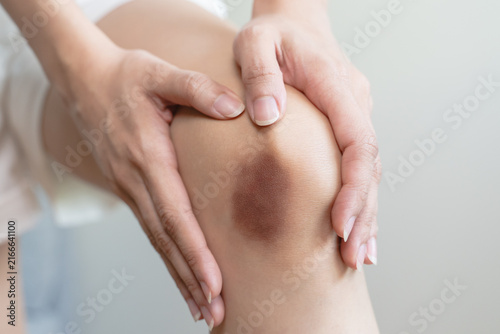 Foto Close up of a painful dark bruise and hematoma on the knee of an Asian woman aft