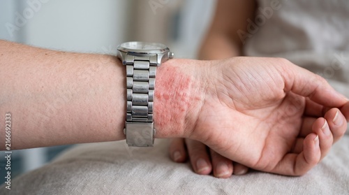 Close up of irritated wrist skin with red rash beneath a metal watch