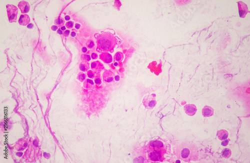 Medical themes: Microscopic image showing metastatic breast adenocarcinoma in pleural fluid.