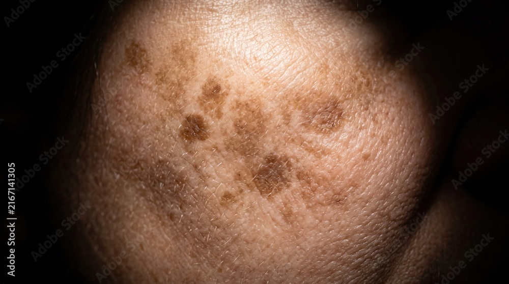 Fototapeta premium Macro Detailed Close Up of Hyperpigmentation Age Spots and Melasma on Human Skin