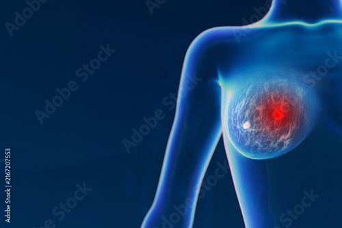 Quadro su tela translucent female torso showing a detailed internal structure of one breast with a prominent, highlighted glowing red tumor nodule on a dark blue background with copy space