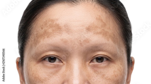 Close up of Asian woman upper face with severe melasma hyperpigmentation and dark sun spots