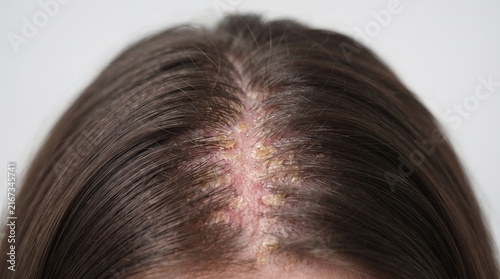 Close Up of Scalp with Severe Psoriasis Seborrheic Dermatitis and Dandruff Flakes