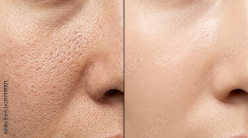 Before and after comparison of skin texture showing enlarged pores and smooth skin.