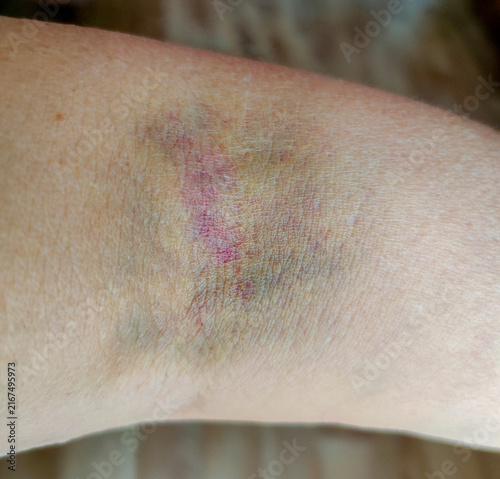 Close-up of a colorful healing bruise in the inner elbow area after a blood draw or injection, showing red, purple, blue-gray, green, and yellow discoloration characteristic of a resolving hematoma.