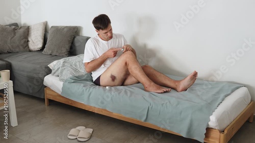 Man applies healing ointment from tube on large bruise on thigh sitting on bed at home. Home treatment and recovery after leg injury and fall, wide shot with person.