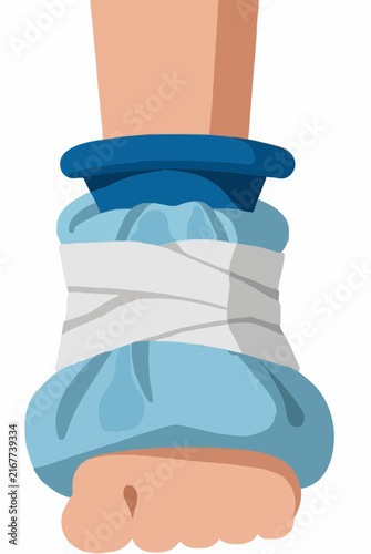 Hand-traced vector illustration of a swollen ankle wrapped in a blue ice pack with white medical bandage, depicting injury recovery and cold therapy treatment for sprain or bruise