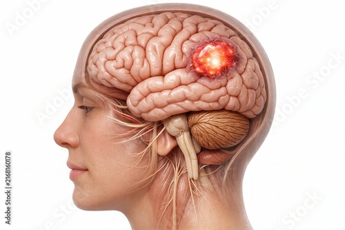 Brain tumor MRI diagnosis medical illustration showing abnormal brain tissue mass within cerebral hemisphere representing neurological oncology detection and clinical imaging evaluation concept
