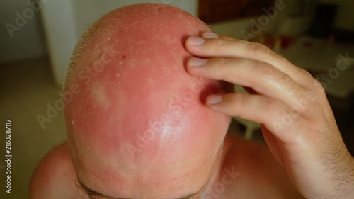 Man touching painful sunburn on bald head after prolonged outdoor exposure. Red scalp with peeling skin in close up. UV radiation damage and sunscreen awareness concept