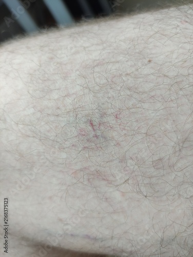 Varicose veins and purple dilated capillaries on hairy leg skin close up