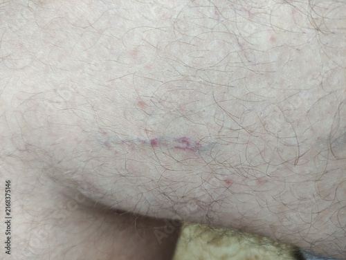Purple spider veins and varicose veins on pale hairy skin of a leg