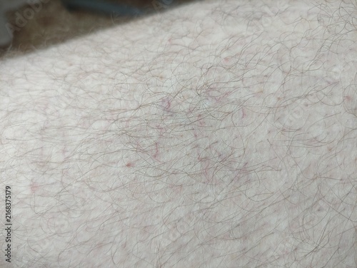 Close up of varicose veins and small red spider veins on hairy pale leg skin