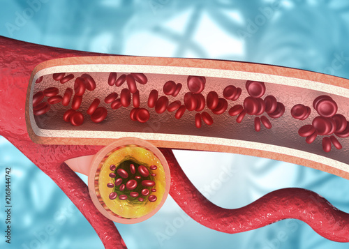 Konstfotografi Three-dimensional illustration of a blood vessel narrowed by yellow cholesterol