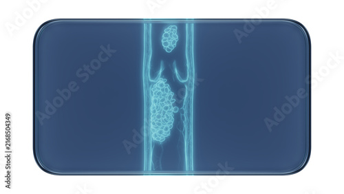 Foto Glass Frame with X-Ray Deep Vein Thrombosis Blood Clot Medical Illustration