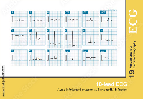 фотографія By adding right ventricular and posterior wall leads to the standard 12-lead ECG, the 18-lead ECG helps detect myocardial ischemia or infarction in specific regions