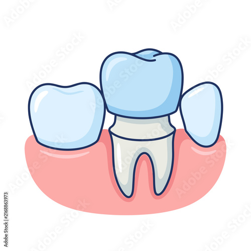 Dental crown sample and adjacent teeth in dental illustration  
