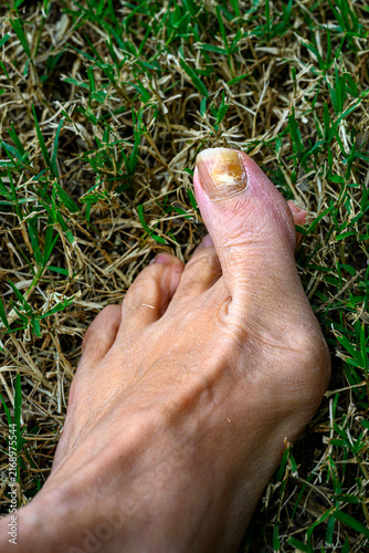 Принти на полотні Foot rests on grass with thick, discolored toenail