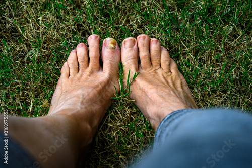 Feet rest on green grass, one toe shows mild infection