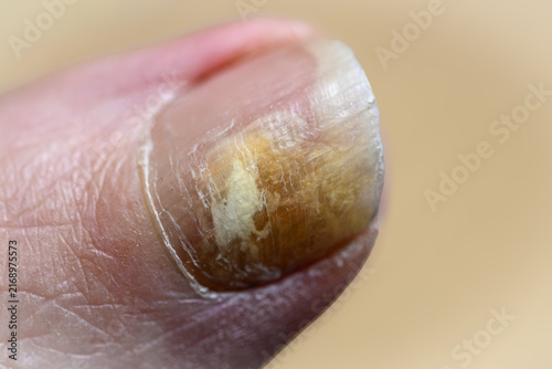 Dull nail shows signs of fungal infection