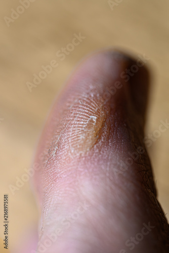 Konstfotografi Close-up of a dry, cracked finger tip
