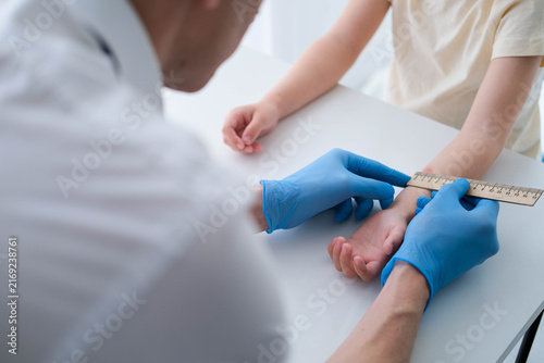 A nurse is doing an important Mantoux test on a child. The doctor measures the Mantoux test with a ruler for a little boy. Positive mantoux reaction, allergy.
