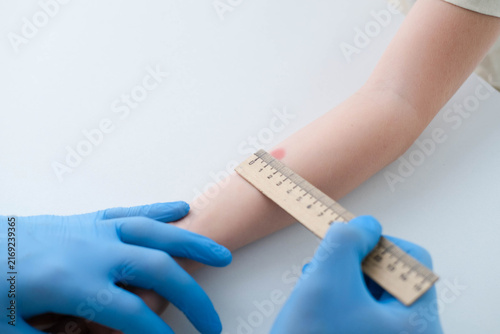 A nurse is doing an important Mantoux test on a child. The doctor measures the Mantoux test with a ruler for a little boy