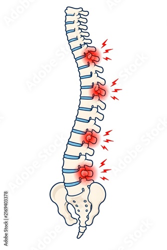  human spine with painful spinal joint
