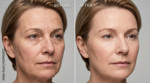 Before and After: Woman's Face Transformation with Skin Rejuvenation Treatment