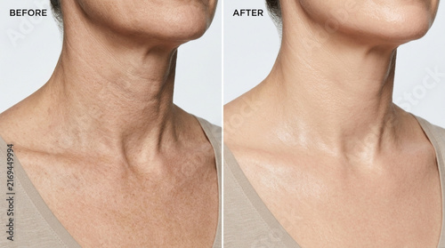 Aging Neck Before and After Skin Tightening Treatment Results