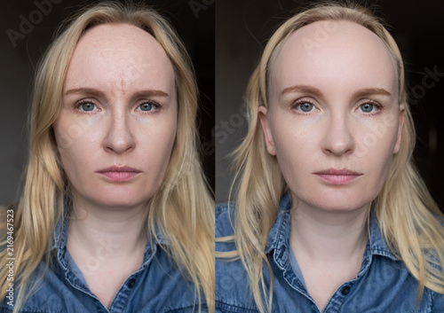 Before and after forehead wrinkle removal, botox injection or face massage. A young woman demonstrates smooth skin after glabella glabellar lines treatment.