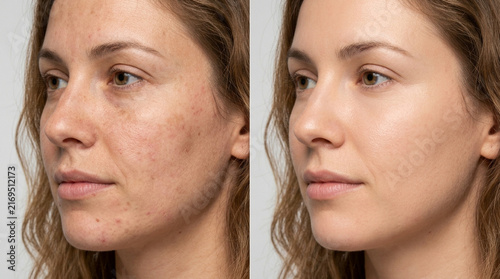 Before and After Skin Treatment: Woman's Face with Hyperpigmentation Compared to Clear Skin