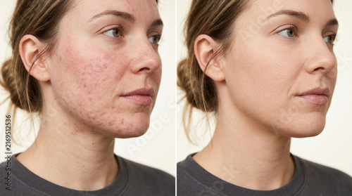 Before and After Skincare: Acne Treatment Comparison, Woman's Face Transformation
