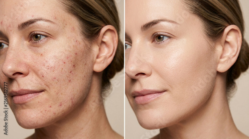 Before and After Skincare Transformation: Acne to Clear Complexion