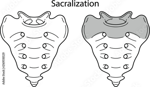 Foto Sacralization medical infographic diagram illustrating lumbar vertebra fusion an
