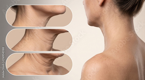 Ehlers Danlos syndrome skin laxity loose neck skin, medical illustration showing reduced skin elasticity and connective tissue disorder