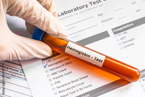 Принти на полотні blood sample in lab tube for Hemoglobin test