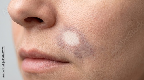 Clinical macro of skin blanching and frosting reaction after laser or cryotherapy treatment.